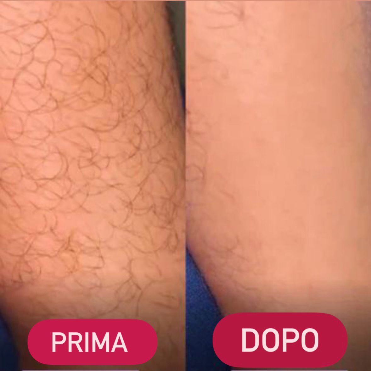 ✨ Epilatore in cristallo: pelle liscia in un attimo, senza dolore 💎